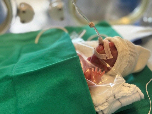 2024년 4월 22일 국내에서 가장 작은 몸무게(260g)로 태어난 예랑이는 출생 직후 신생아중환자실로 옮겨져 24시간 집중 관리를 받았다. [삼성서울병원 제공]